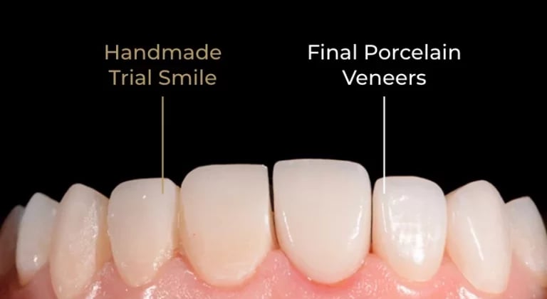 Veneers-jpg-e1675420658230-768x420